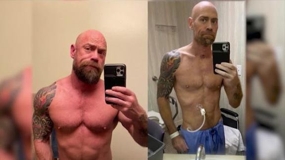 COVID-19 survivor, male nurse shares shocking transformation pictures