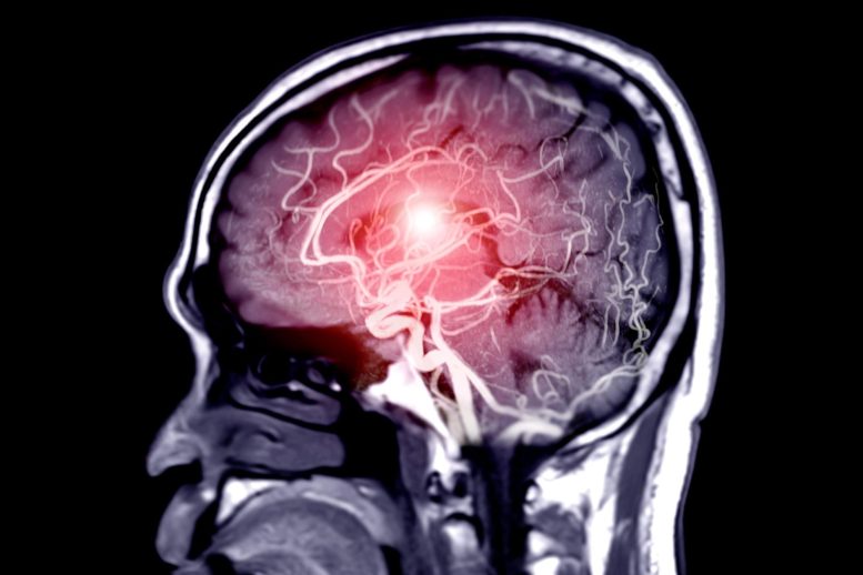 Brain Blood Flow MRI
