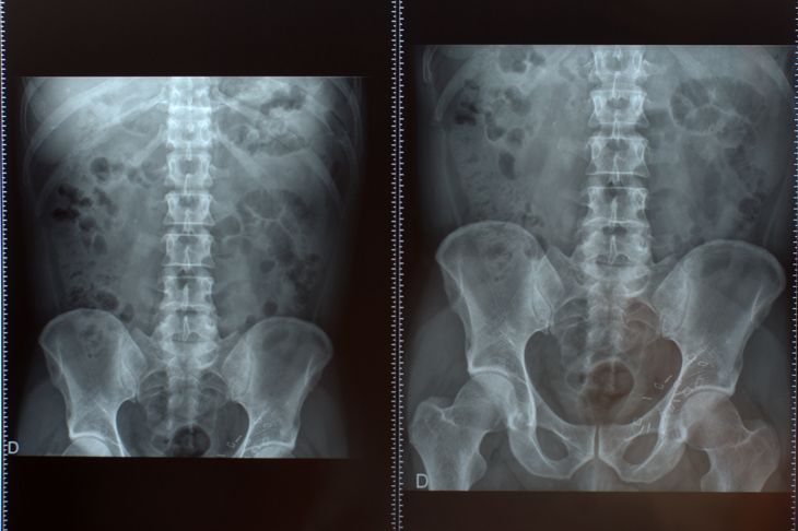 X-rays of the spine and abdominal area