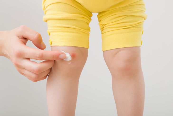Hand applying ointment to toddler's knee wear