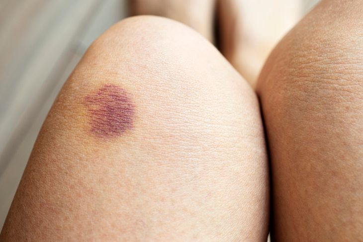 bruise on someone's knee