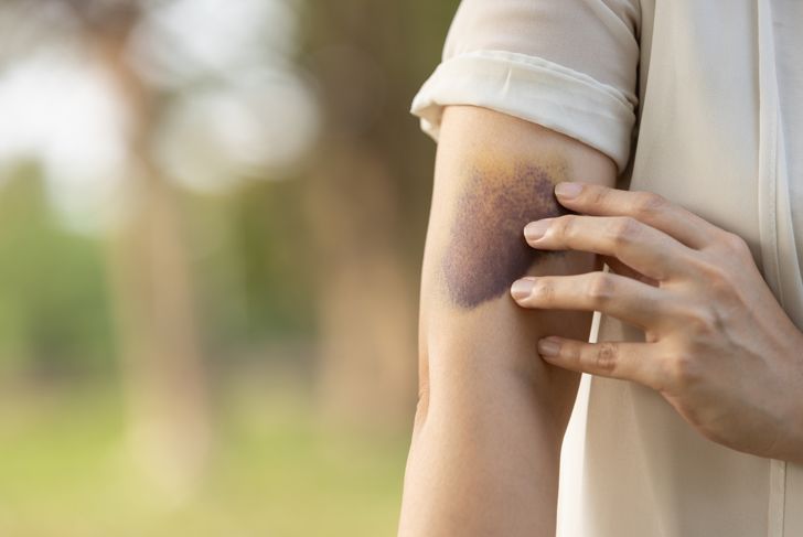 Woman with bruised arm