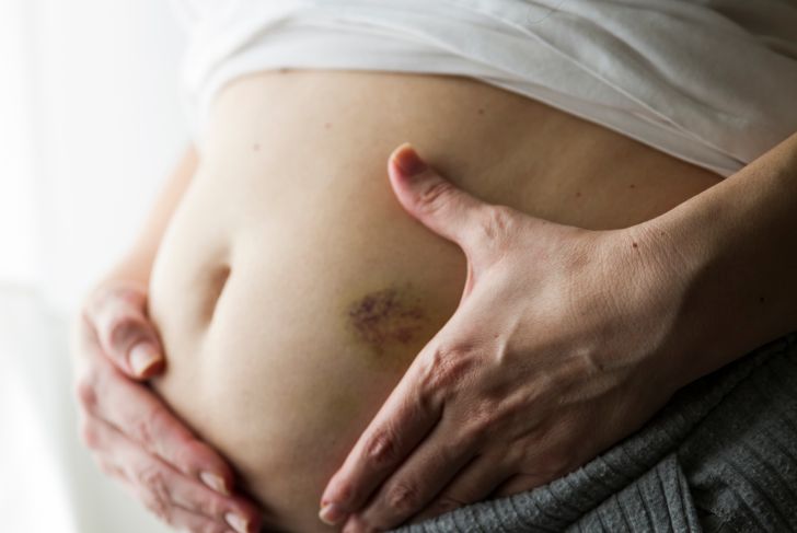 woman with stomach with bruise